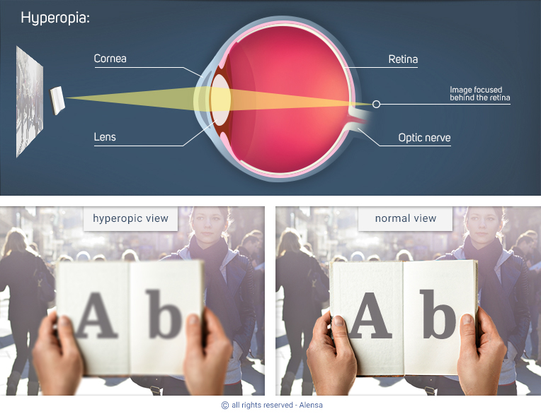 Explanation of hyperopia and comparison of hyperopic view with normal view