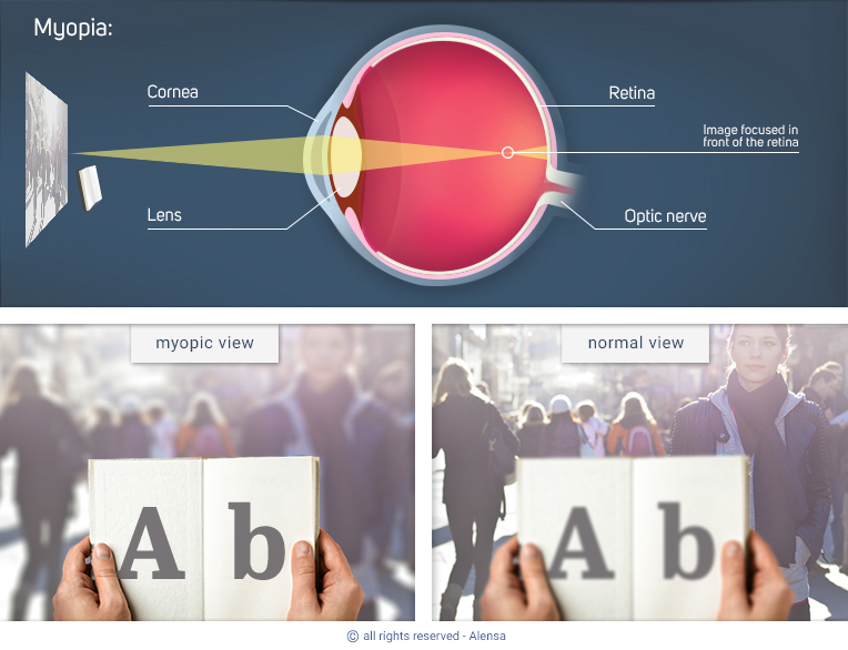 Explanation of myopia and comparison of myopic view with normal view