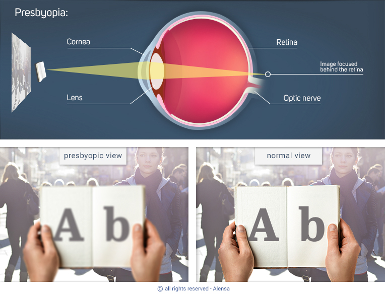 Explanation of presbyopia and comparison of presbyopic view with normal view